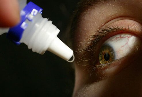 Antibiotics, in the form of eyedrops, pills, or ointment, are the recommended treatment for bacterial pink eye.