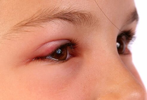 A young girl with a swollen eyelid from pinkeye