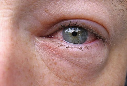 Increased production of tears (watery eyes) is common in viral and allergic pink eye.