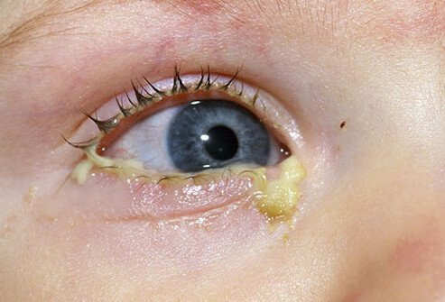 Acute bacterial conjunctivitis with pus around the eye