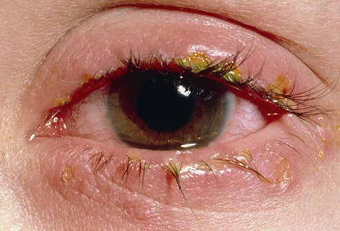Crusts on a swollen eyelid from a viral infection.