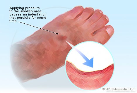 Pitting Edema Illustration