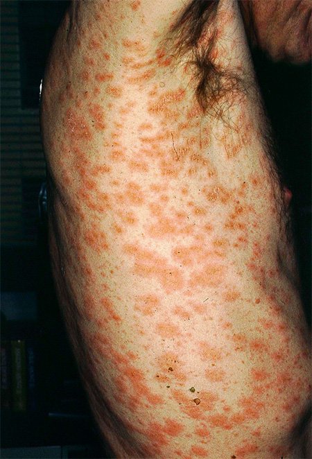 Picture of pityriasis rosea on the torso