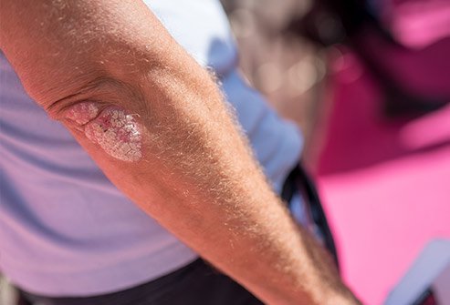 psoriasis