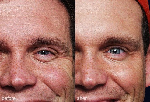 Botox is a common procedure to reduce the look of lines and wrinkles.