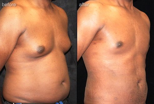 Liposuction removes unwanted fat to sculpt areas of the body.