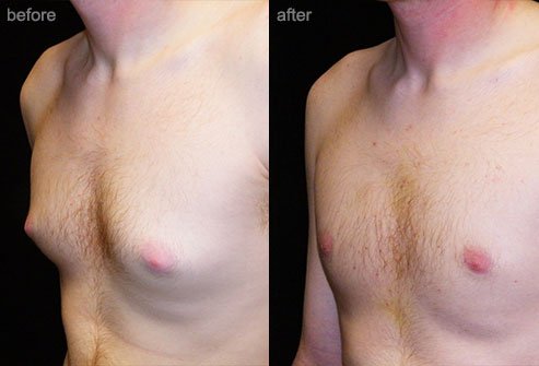 Breast reduction may be performed in men using liposuction or surgery.