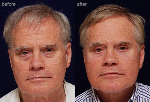 Facelifts tighten sagging skin and reduce the appearance of deep skin folds.