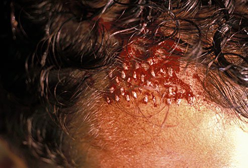 A hair transplant involves removing hair from the back of the head and implanting it into areas that are thinning.