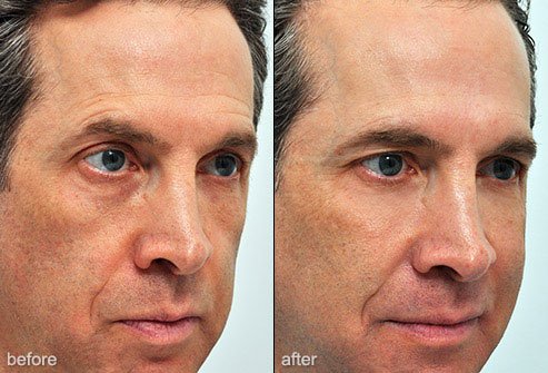 Fillers can be used to give the face a more youthful appearance.