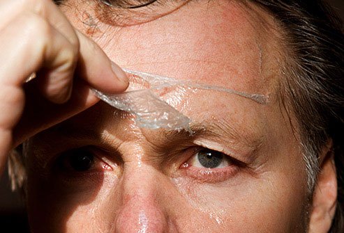 Chemical peels remove the top layers of skin revealing healthy, younger-looking skin underneath.