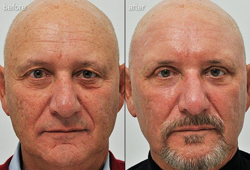 Laser skin resurfacing removes damaged layers of skin so that healthier skin can emerge.