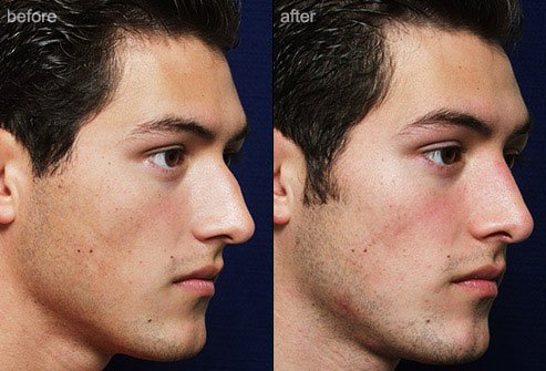 Rhinoplasty is surgical alteration of the nose for cosmetic or functional purposes or both.