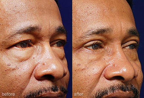 Eyelid surgery can create a more youthful appearance.