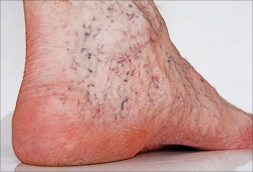 A doctor can use laser therapy to remove spider veins.