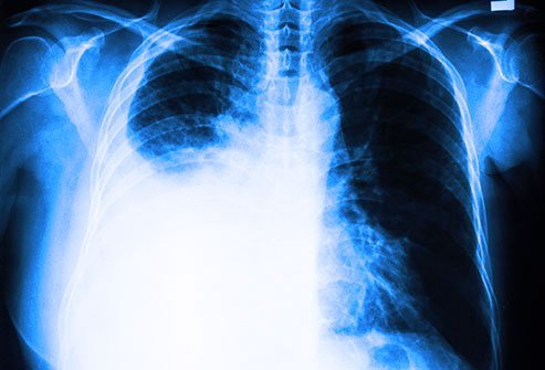 Chest X-rays can detect pleural effusions, which often appear as white areas at the lung base.