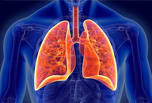 Pleurisy is swelling and irritation of the tissues between the lungs and chest wall/rib cage