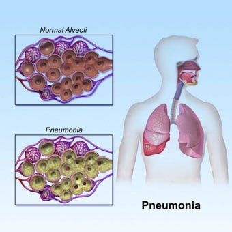 Community-acquired pneumonia (CAP) is most common in winter months.