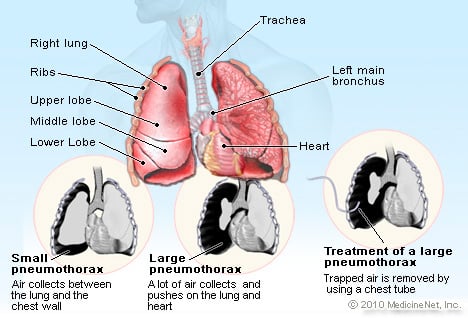 Pneumothorax Illustration