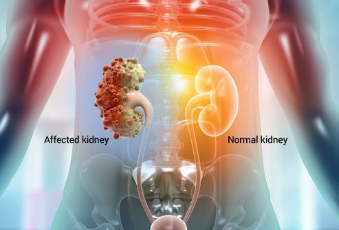 Picture of a healthy kidney and multiple cysts on a kidney.