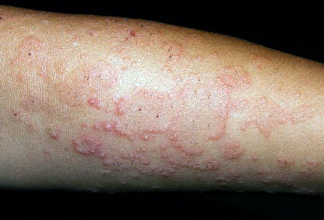 how to get rid of polymorphous light eruption