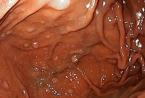 Some forms of stomach polyp can be precursors of cancer.