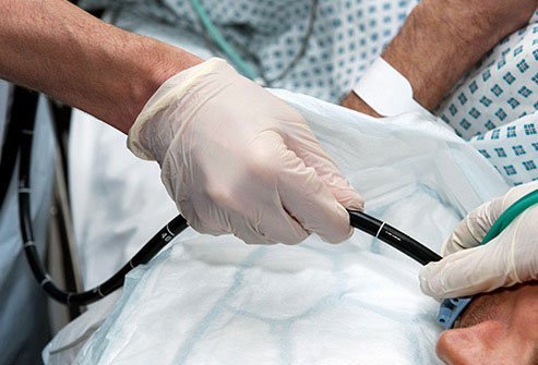 Polypectomy for stomach polyps is typically done using an endoscope.