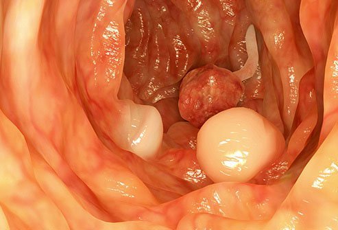 Half of all adults may have colon polyps in the United States.