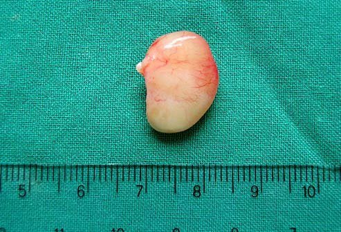 Nasal polyps can cause your sense of smell to diminish.