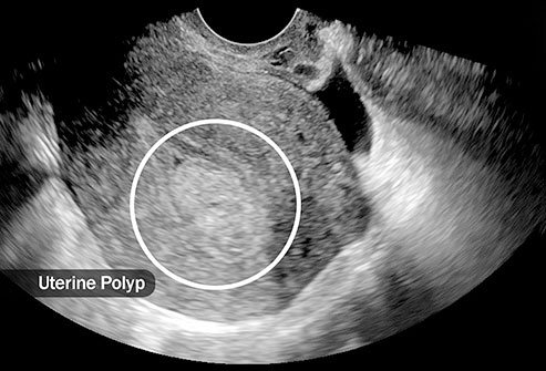 Endometrial polyps are noncancerous.