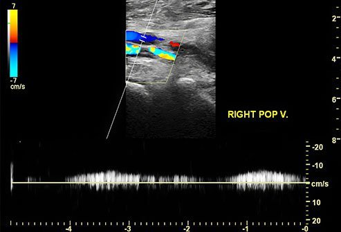 Black-and-white radiological image with measuring lines and color code showing the popliteal nerve.