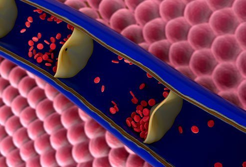 Portal hypertension occurs when blood flow through the liver is obstructed.