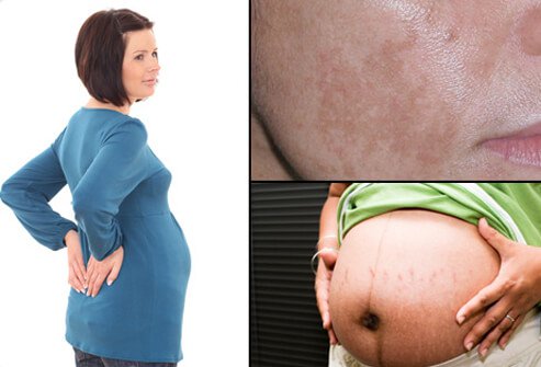 A pregnant woman with back pain (left), pregnant woman with stretch marks and line running down her belly (center), and woman with melasma (pregnancy mask) on her cheek (right).