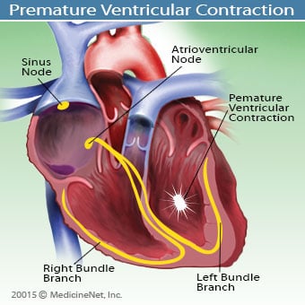 An illustration shows what occurs during a premature ventricular contraction.