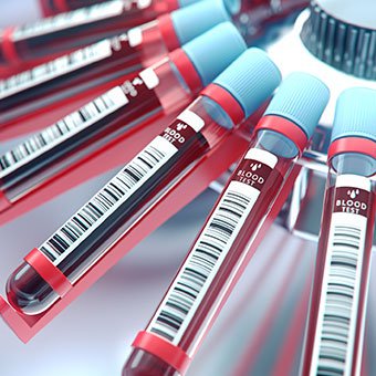 ECST and blood tests can be used to diagnose premature ventricular contractions.