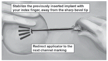 Instrument stand - Illustration