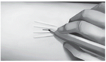 Use the technique of spreading and closing with either
the iris scissors or mosquito forceps to separate the fibrous tissue - Illustration