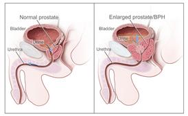 Picture of benign prostatic hyperplasis (BPH)
