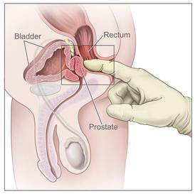 Picture of a digital rectal exam (DRE)