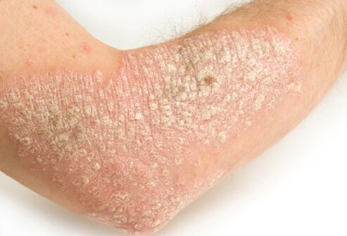 Psoriasis is an autoimmune disorder in which your skin cells rapidly reproduce, creating raised, red and scaly patches of skin.