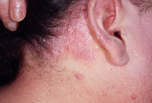 Picture of Psoriasis of the Scalp