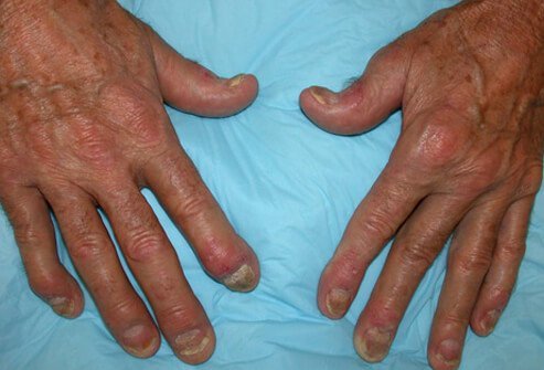 Picture of Psoriatic Arthritis