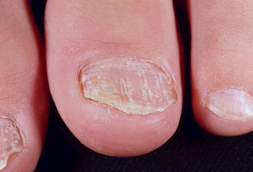 In some cases, psoriasis may involve only the fingernails and toenails, although more commonly, nail symptoms will accompany psoriasis and arthritis symptoms.