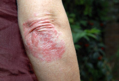 It is also referred to as plaque psoriasis because of the well-defined areas of raised red skin that characterize this form.