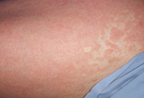 It appears as a red, peeling rash that often itches or burns.