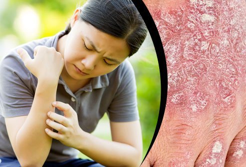 Stress is a common trigger of psoriasis, a disease that causes skin plaques to form, especially on the scalp, knees, and elbows.