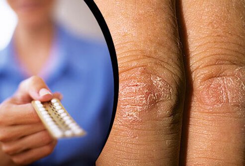 Hormones changes usually precede psoriasis and can influence the severity. 