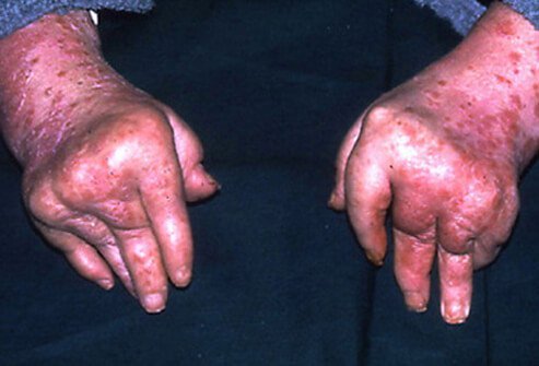 Arthritis mutilans is the least common form of psoriatic arthritis, but the most severe, causing degeneration and deformity.
