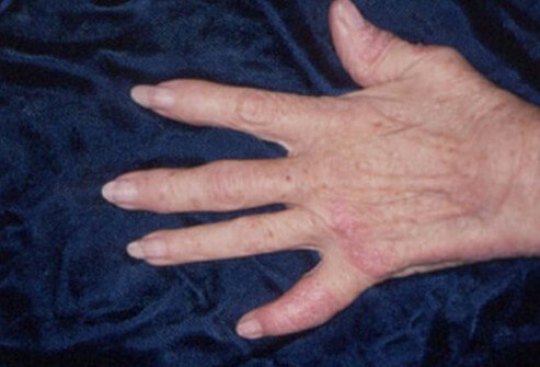 Most people have psoriasis for years before they develop psoriatic arthritis.