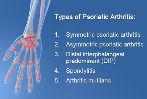 There are five types of psoriatic arthritis, based on the parts of the body that are affected and the severity of the inflammation.